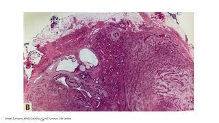 BREASTPATH 20240719 Breast fibroepithelial lesions fibroadenoma phyllodes tumor hamartoma [upl. by Ellainad]