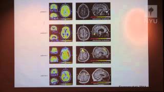 Nicholas Schiff Measurements of Consciousness in the SeverelyInjured Brain [upl. by Mungovan994]