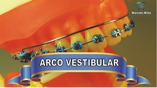 ARCO VESTIBULAR ACESSÓRIO para expansão dentoalveolar [upl. by Conners936]