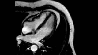 Constrictive pericarditis fourchamber ECGgated cine SSFP MR [upl. by Savory942]