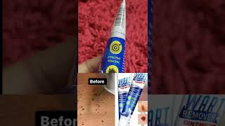 Salicylic acid wart removal  Does wart removal really work  Honest Review [upl. by Ordway]