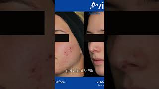 Did you know AviClear targets acne at the source the sebaceous glands that cause acne [upl. by Jea]