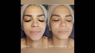 BioMicroneedling Procedure [upl. by Oeram327]