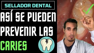 Cómo PREVENIR las CARIES en NIÑOS  SELLADORES de fosetas y FISURAS [upl. by Alyat]