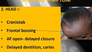 Clinical features of rickets Part 13  Rickets  Pediatrics [upl. by Ahsauqal]