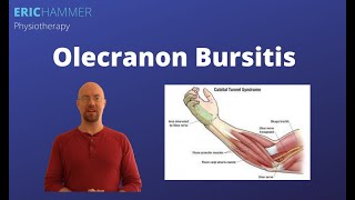 Olecranon Bursitis [upl. by Nylessej443]