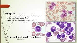 Practical Hematology 11 Morphology of Benign WBCs disorders [upl. by Nilauqcaj]