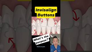 How Invisalign Attachments Work The Key to Faster Results dentallan dentist shorts [upl. by Bancroft]