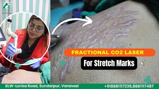 Stretch Mark in Pregnancy  Get Rid of Stretch Mark at Atomic Clinic by Dr Sneha Gupta [upl. by Zachery]