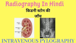 IVP  INTRAVENOUS PYLOGRAPHY  INTRAVENOUS UROGRAPHY [upl. by Ahsrav]