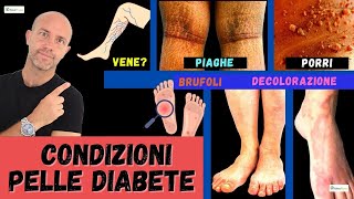 Le 7 condizioni sulla PELLE che ti dicono che hai il DIABETE di tipo 1 e 2 [upl. by Sell745]