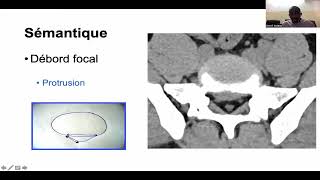 PATHOLOGIE DÉGÉNÉRATIVE DU RACHIS LOMBAIRE [upl. by Enitram]