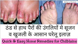 ठंड से हाथ पैरों की उंगलियों मे सूजन व खुजली का इलाज़ Remedies for Chilblains हथेली तलवे में खुजली [upl. by Ahtreb]