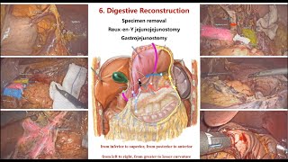 Laparoscopic Distal Gastrectomy With D2 Lymphadenectomy amp Intracorporal RouxenY Gastrojejunostomy [upl. by Naillimixam]