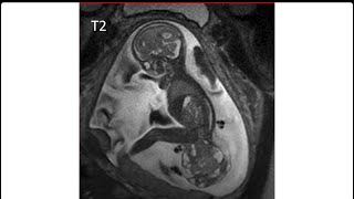 sacrococcygeal teratoma type 1 [upl. by Chatwin]