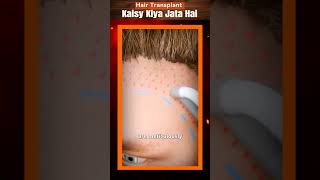 Hair Transplant Kaisy Kiya Jata Hai shorts reels viral facts [upl. by Els]