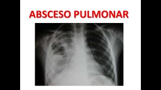 Diagnostico y tratamiento del Absceso Pulmonar MEDICINA INTERNA [upl. by Yelsnya]