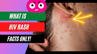 Is Skin rash a symptom of HIV infection [upl. by Samal]