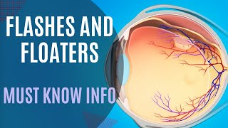 Flashes Floaters Posterior Vitreous Detachment vs Retinal Detachment [upl. by Eckart114]