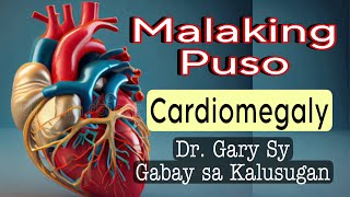 Cardiomegaly Enlarged Heart  Dr Gary Sy [upl. by Leanatan]