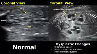 Fetal Kidneys Ultrasound Normal VS Abnormal Image Appearances  Kidney Abnormalities USG  ObGynae [upl. by Jarin58]