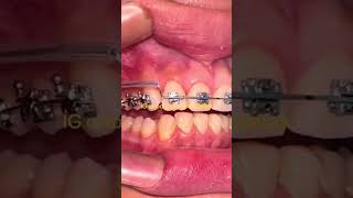 Class II2 malocclusion orthodontic ортодонтия kieferorthopädie विषमदंत ortodonzia orthodontie [upl. by Emera43]