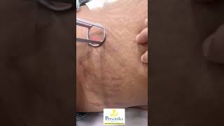 Laser Stretch Marks Removal Treatment In Hyderabad  Best Treatment For Stretch Marks  Hyderabad [upl. by Elleraj171]