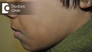 How to cure white patches on face in a young individual  Dr Rasya Dixit [upl. by Nieberg]