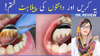 The 1 Top Remedy for Dental Plaque TARTAR [upl. by Ailerua]