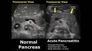 Pancreas Ultrasound Normal Vs Abnormal Image Appearances Comparison  Pancreatic Pathologies USG [upl. by Annodal]