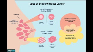 Treatment of Ductal Carcinoma in Situ [upl. by Anuahc]