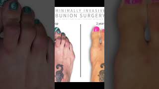 Revolutionary Minimally Invasive Bunion Surgery A Step Towards PainFree Feet [upl. by Anayk]