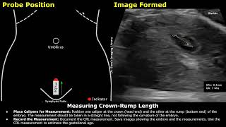 Step By Step Guide On 7 Week Pregnancy Transabdominal Ultrasound Scan  Full Protocol With Reporting [upl. by Atimed]