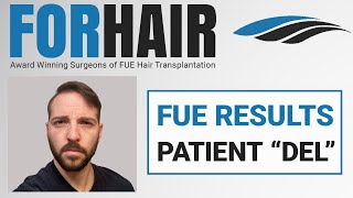 From Norwood 6 to Full Head of Hair  Patient DEL Hair Transplant by Dr Cole [upl. by Acnairb]