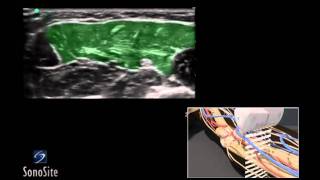 How To Ultrasound Guided Median and Ulnar Nerve Block 3D Video [upl. by Direj]