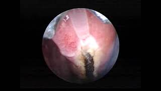 Lower Turbinate coagulation with Infrared Rapido ENT laser [upl. by Bary]