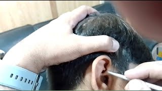 Removing Overflowed Ear wax  ear wax removal asmrearwax satisfying [upl. by Thomasina]