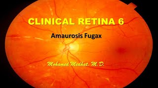 Clinical Retina 6  Amaurosis Fugax [upl. by Wendalyn877]