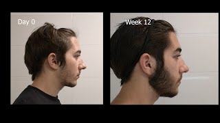 Minoxidil Beard Growth  3 Month Transformation  Timelapse BEFORE and AFTER [upl. by Parik333]