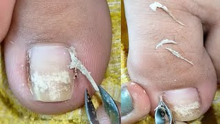 Huge ingrown toenail removal nail​​​ nailart fyp ear shorts viral wax [upl. by Toolis724]