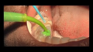 Composite restoration in less than 10 minutes by Dr Adham Elsayed [upl. by Eleahcim]