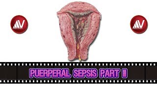 Puerperal Sepsis Part II [upl. by Aerdnod]