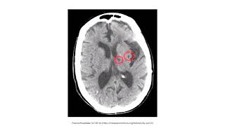 Cerebrovascular Disease for the USMLE Step 1 [upl. by Kayla680]