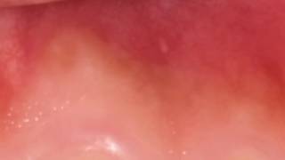 यह लक्षण दिखें तो तुरंत डॉक्टर के पास जाइए मुंह का कैंसर हो सकता है Mouth Cancer Ke Lakshan Symptoms [upl. by Meerak]