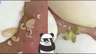 Ultimate Satisfying Pimple Popping Compilation 2024  Best Blackhead amp Acne Removal Video [upl. by Schwerin]