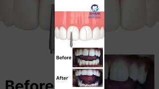 Before amp After Filling Gaps Between Teeth  Shahi Dental Clinic Muzaffarpur [upl. by Ydasahc]