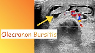 Olecranon Bursitis Ultrasound [upl. by Yelsel]