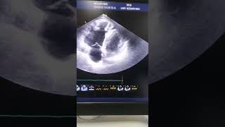 Arrhythmogenic right ventricular Dyspalsia ARVD ECHO [upl. by Couchman]