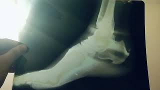 calcaneal spur orthopedics bones medicine surgery [upl. by Fenwick147]