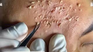 Acne amp Blackhead Treatment Blackhead Removal on forehead  Remove Blackhead removeblackhead [upl. by Goss994]